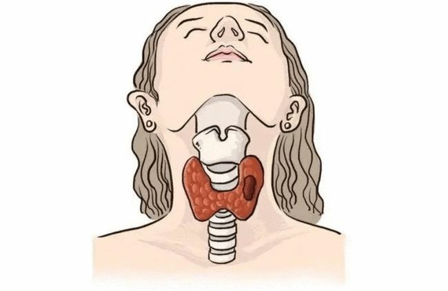 日本美國甲狀腺癌新藥靶向藥，甲狀腺癌出國看病新進(jìn)展
