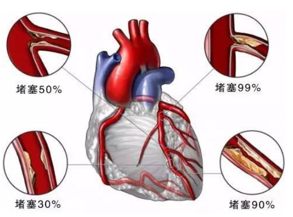 日本預(yù)防心臟病