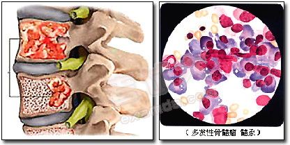 日本骨髓瘤治療方法