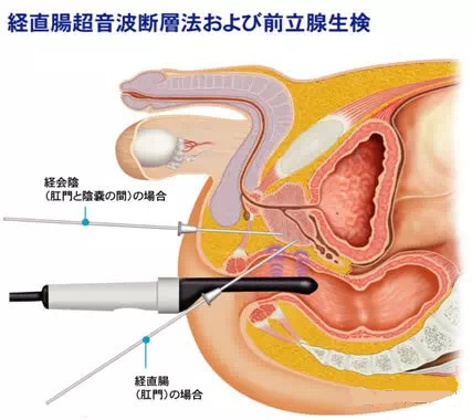 日本前列腺檢查