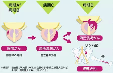 日本前列腺檢查