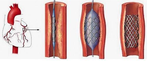 心臟病血管狹窄日本怎么治