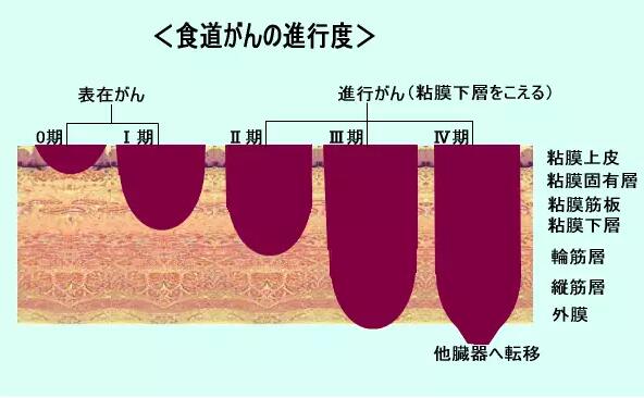 食道癌患者如何到日本看病