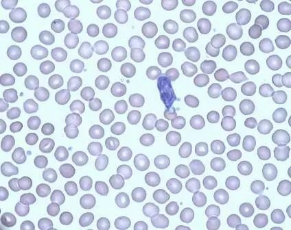 日本兒童腫惡性瘤治療方法