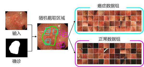 AI高精度檢測早期胃癌
