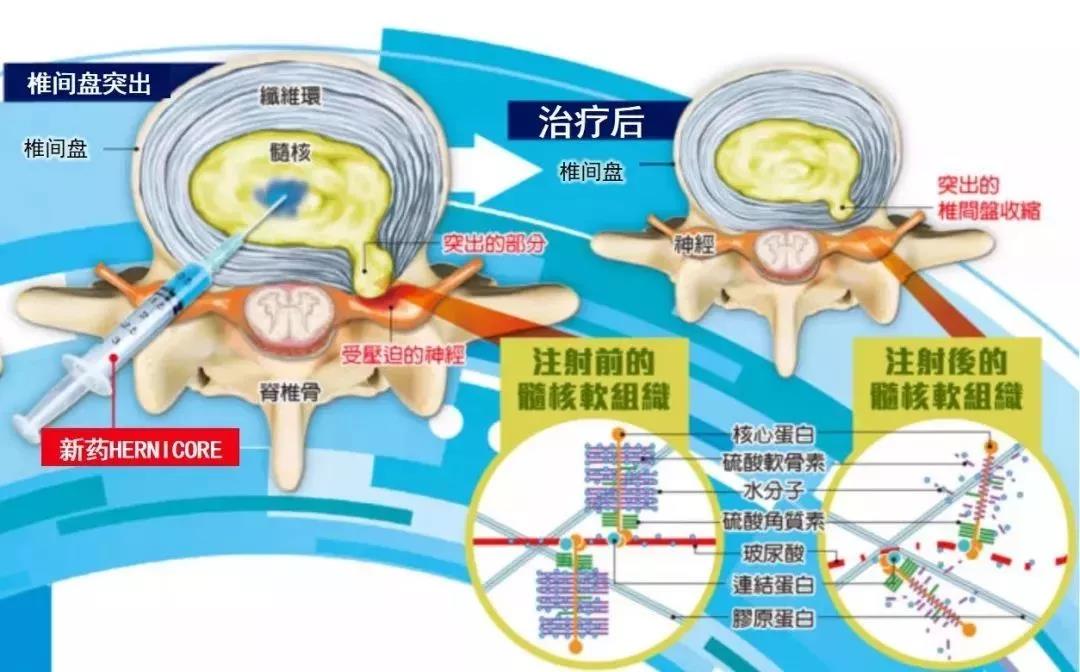 腰間盤突出