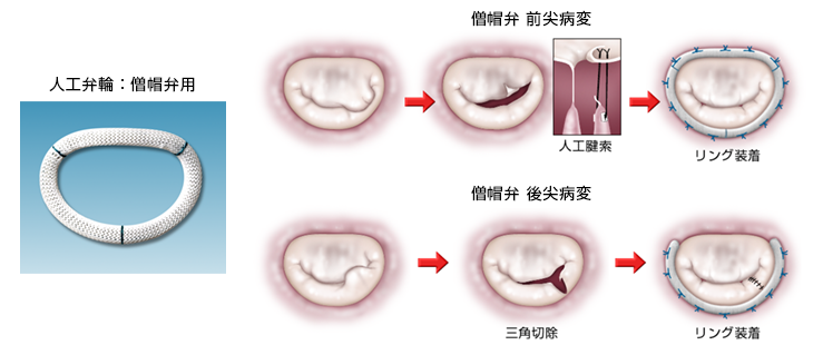 心臟瓣膜病