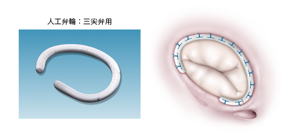 心臟瓣膜病