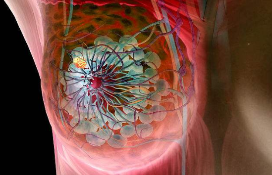 美國(guó)乳腺癌治療