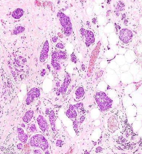 美國(guó)治療乳腺癌