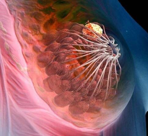 美國(guó)乳腺癌治療