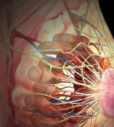 出國看病乳腺癌