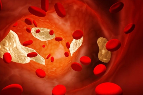 如何預(yù)防動(dòng)脈粥樣硬化