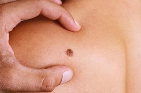 黑色素瘤皮膚癌