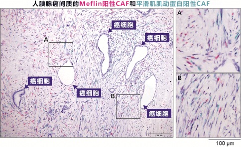 胰腺癌出國治療：這種細(xì)胞竟然可以抑制胰腺癌生長？