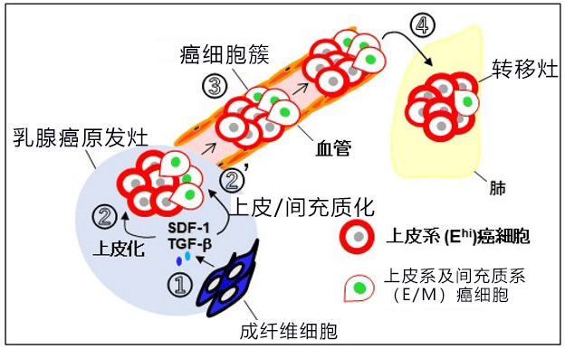 乳腺癌出國(guó)治療：日本研究人員發(fā)現(xiàn)乳腺癌浸潤(rùn)轉(zhuǎn)移新機(jī)制！