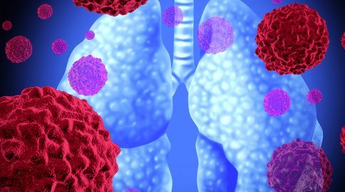肺癌出國(guó)治療：自身抗體檢測(cè)聯(lián)合CT成像可提高肺癌五年內(nèi)生存率！