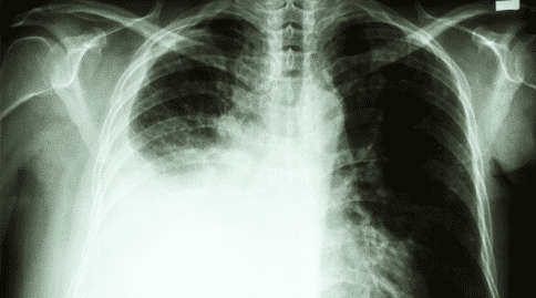 肺癌出國(guó)治療：自身抗體檢測(cè)聯(lián)合CT成像可提高肺癌五年內(nèi)生存率！