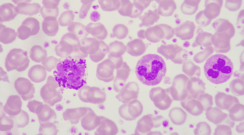 出國看?。貉芯堪l(fā)現(xiàn)白血病治療方法或可治療兒童腦瘤！