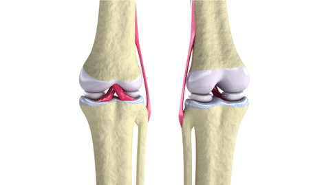 出國看?。盒卵芯繛樾宏P(guān)節(jié)炎預(yù)測和治療帶來新方向！