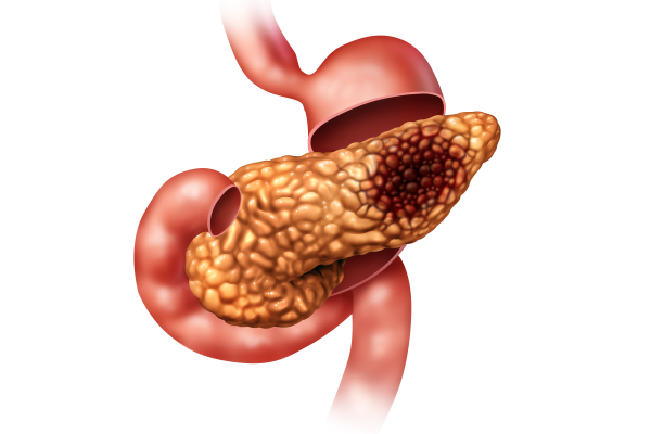 癌癥出國(guó)治療：胰腺癌怎么治療？新研究可為胰腺癌放射治療提供新方向