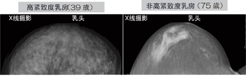 乳腺癌如何檢查？日本開發(fā)出一種新技能可用于早期檢測乳腺癌