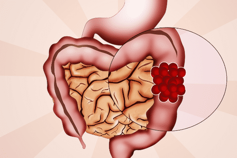 結腸癌預防與治療