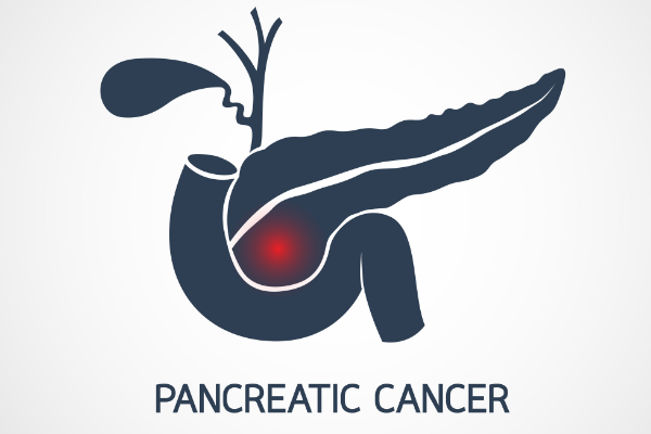 研究發(fā)現(xiàn)一種新的“虛擬活組織檢查”可以分辨出胰腺囊腫的良惡性！