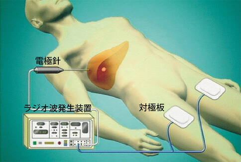 肝癌射頻消融術(shù)