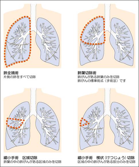 日本肺癌手術治療方法