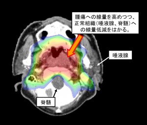 調(diào)強(qiáng)放療治療鼻咽癌