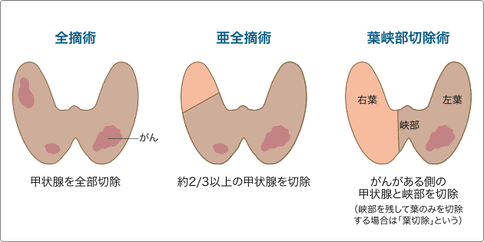 日本治療甲狀腺癌