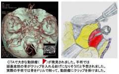 腦動脈瘤治療,腦動脈瘤,腦動脈瘤復(fù)發(fā)風(fēng)險
