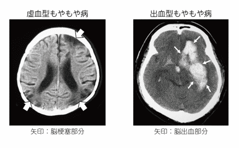 煙霧病預(yù)后