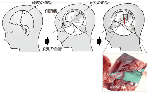 煙霧病手術(shù)效果