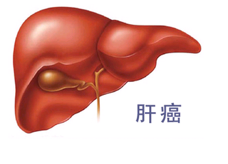 晚期肝癌治療