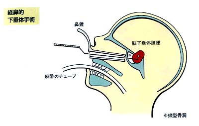 女性腦垂體瘤手術(shù)治療方法