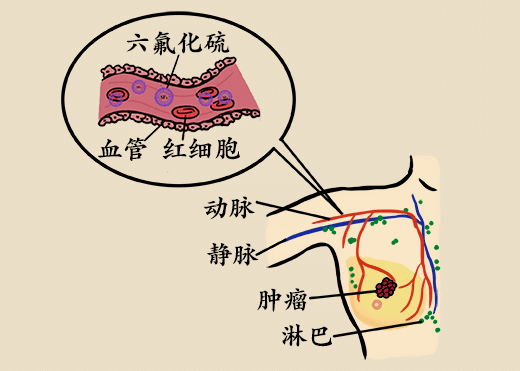 乳房腫塊