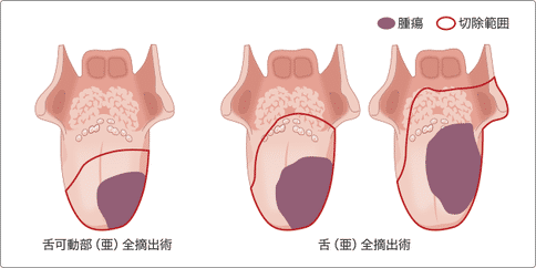 舌癌