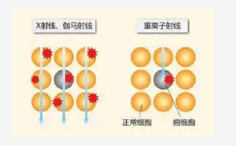 質(zhì)子重離子治療