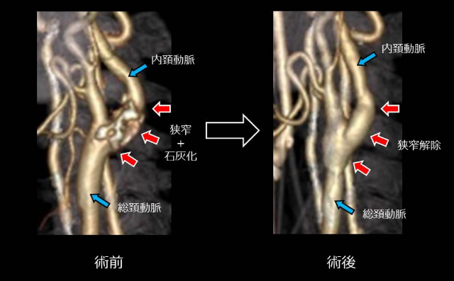 輕度頸動脈狹窄治療