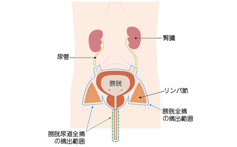 膀胱癌治療方法