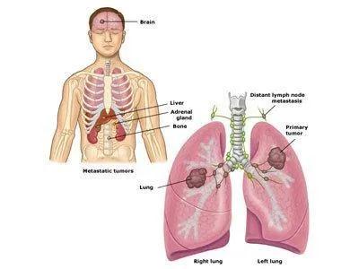 肺癌腦轉(zhuǎn)移