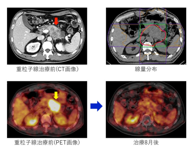 重離子治療