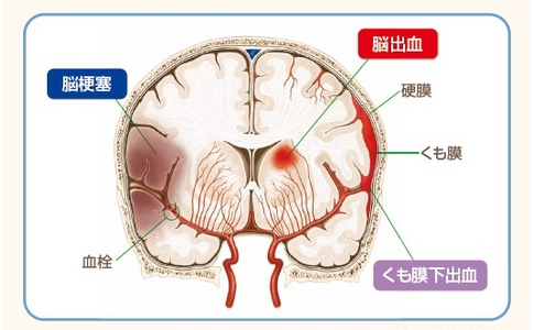 腦梗康復(fù)治療