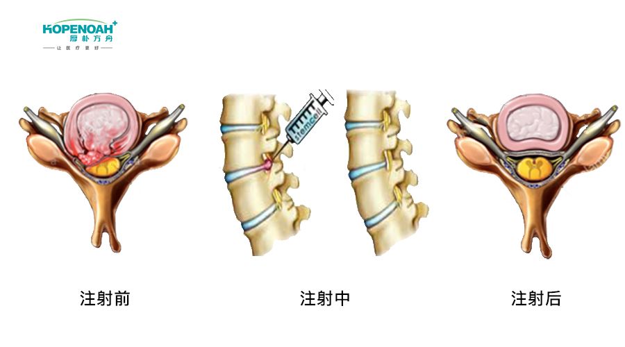 腰椎間盤突出治療流程