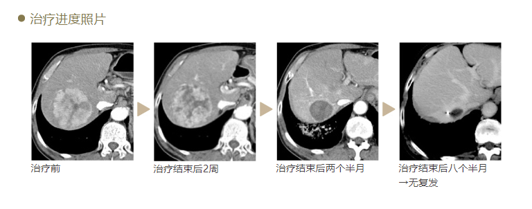 肝癌治療的效果