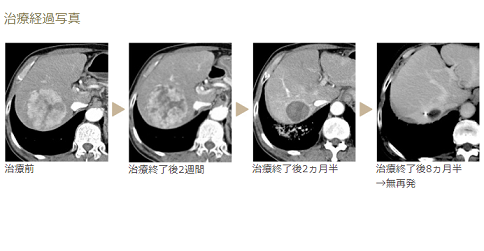 肝癌質子治療