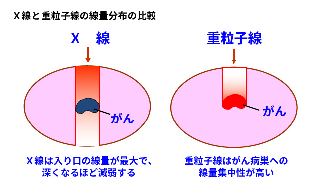 重離子治療骨肉瘤特點(diǎn)