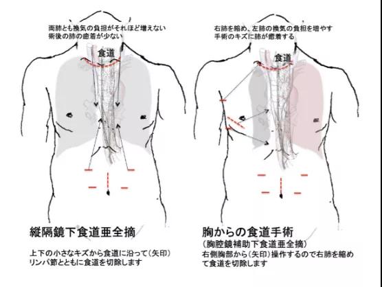 三井記念醫(yī)院治療食管癌